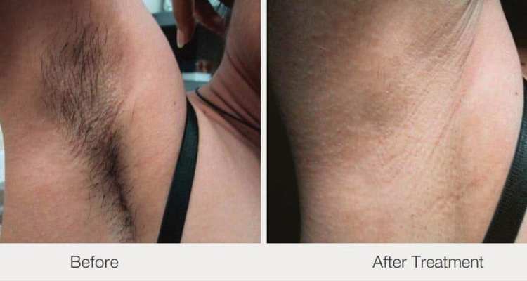 Feel The Difference With Ice Laser Hair Removal Treatment